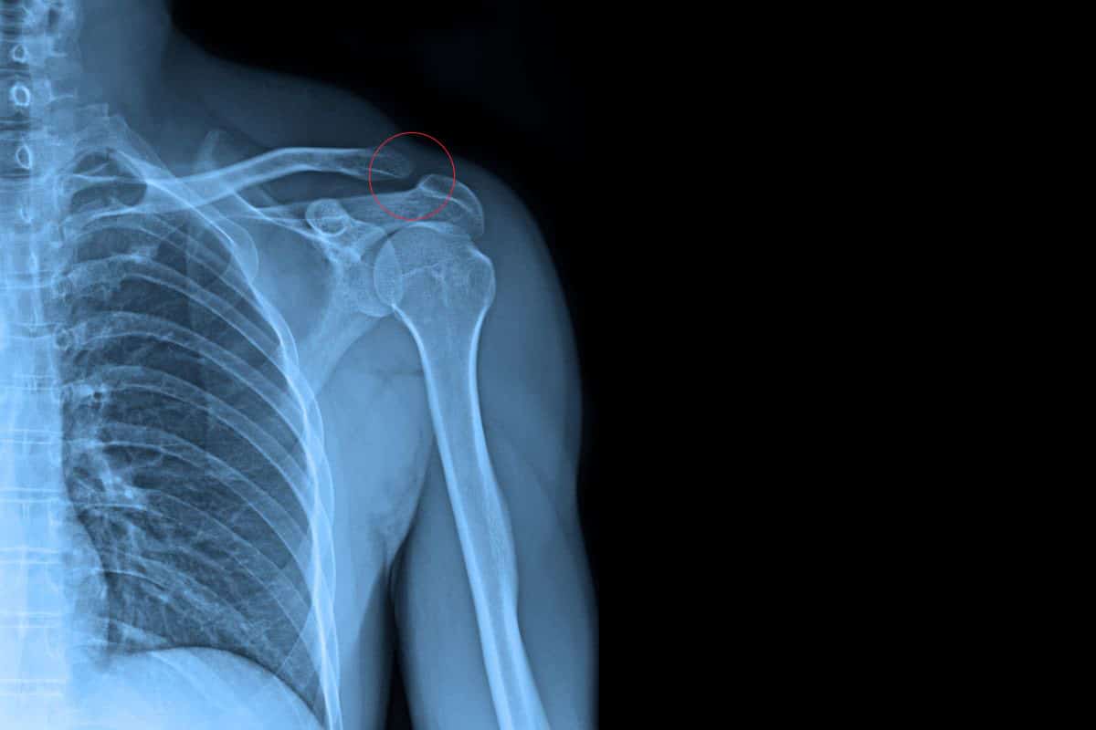 AC-Gelenk-Röntgenbild-Physiotherapie-Binningen-Basel